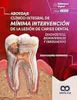 ABORDAJE CLÍNICO INTEGRAL DE MÍNIMA INTERVENCIÓN DE LA LESIÓN DE CARIES DENTAL